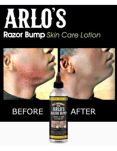 Arlos Razor Bump Skin Care Lotion Arlos Razor Bump Skin Care Lotion